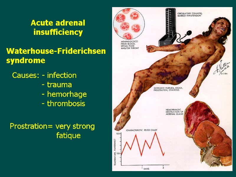 Acute adrenal insufficiency  Waterhouse-Friderichsen syndrome Prostration= very strong     